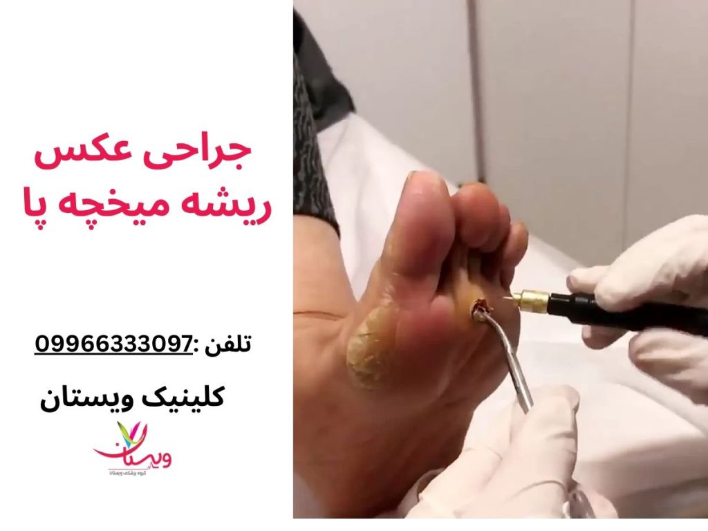 جراحی میخچه پا