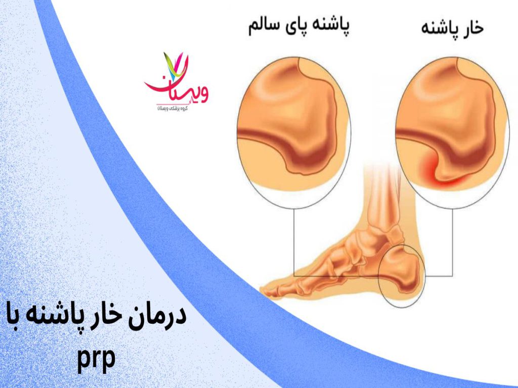 درمان خار پاشنه درمان خار پاشنه با prp