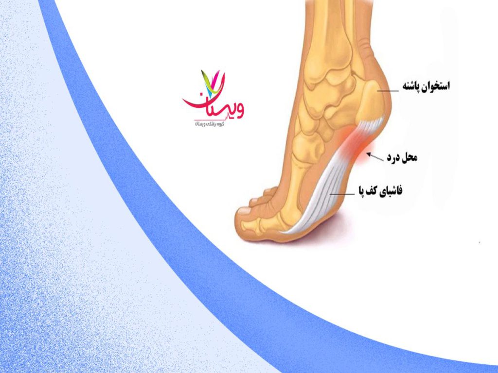 مشکل استخوانی و التهاب رباط درمان خار پاشنه با سنگ پا