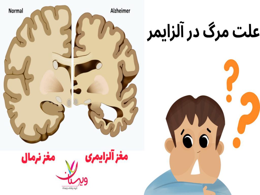 آسیب به مرکز کنترل تنفس علت مرگ در آلزایمر