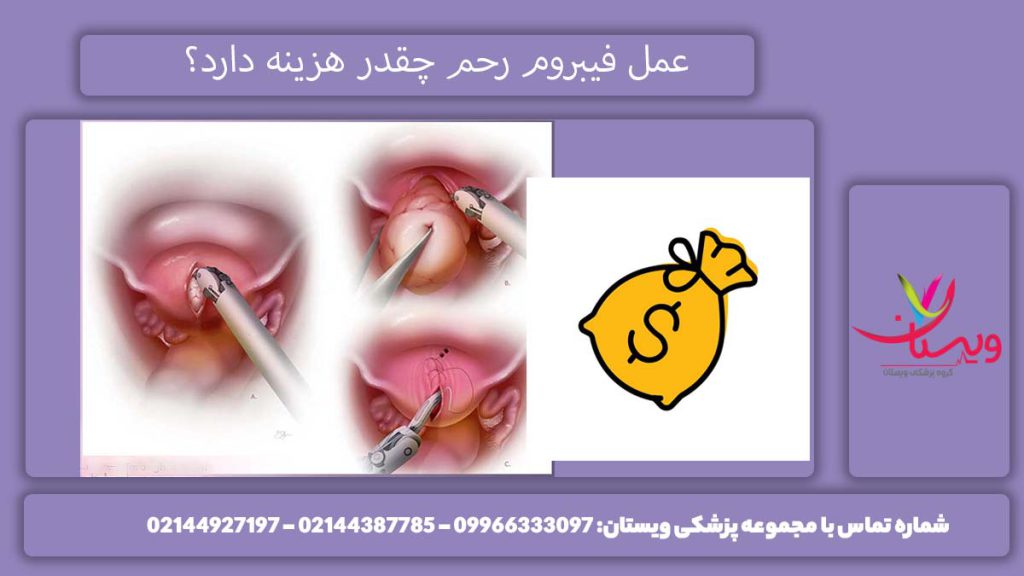میزان هزینه عمل فبیروم رحم