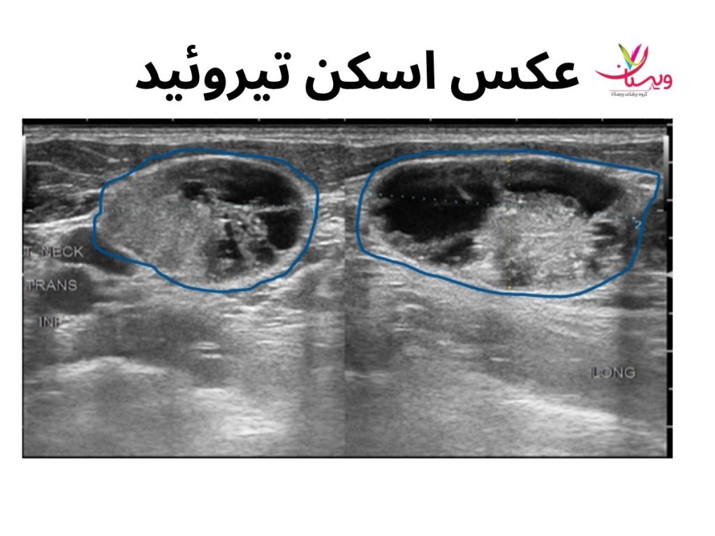 عکس اسکن تیروئید