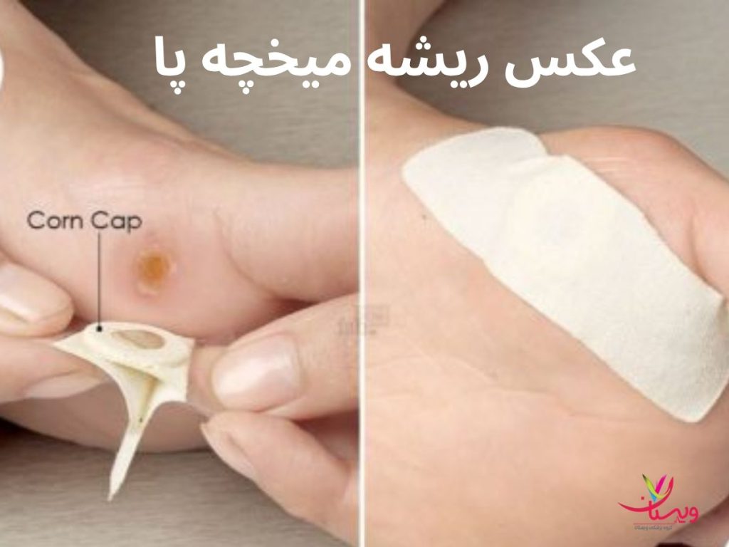 عکس ریشه میخچه پا نی نی سایت