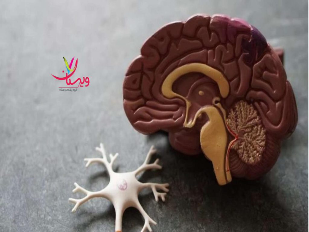 زوال عقل مراحل پایانی الزایمر چیست