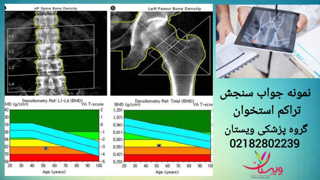 نمونه جواب سنجش تراکم استخوان
