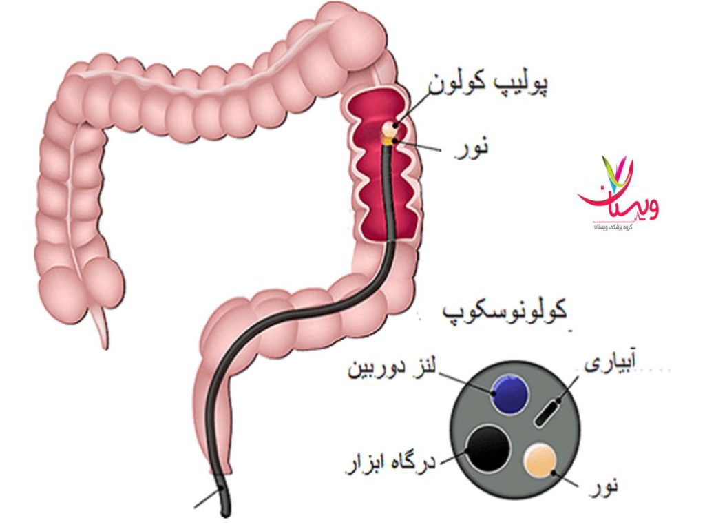 آندوسکوپی با بیهوشی هزینه آندوسکوپی با بیهوشی