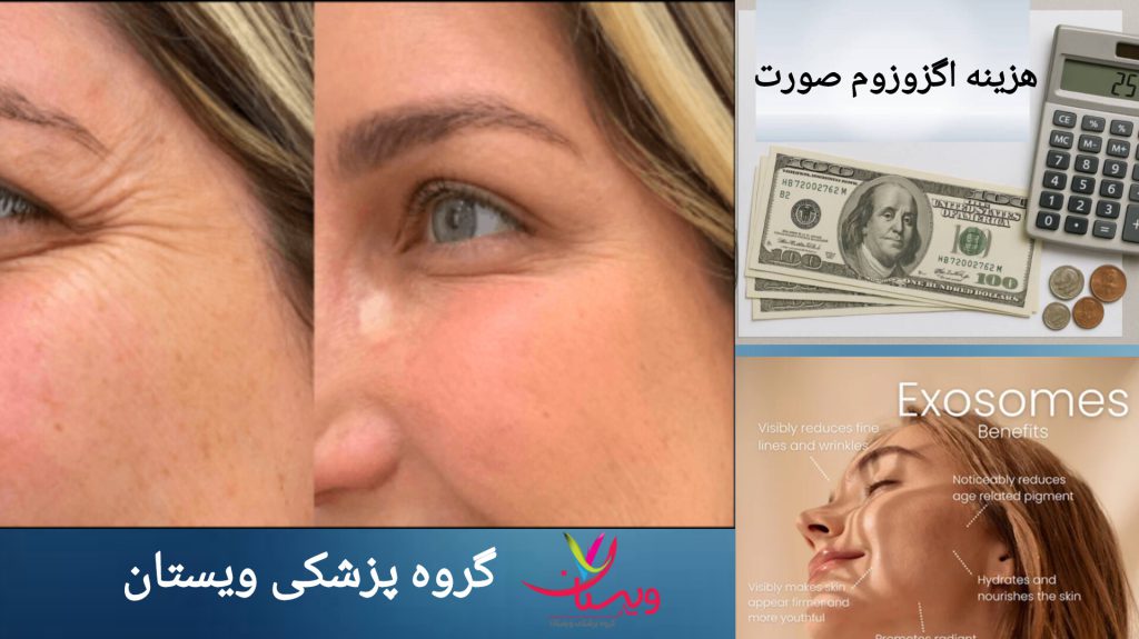 تصویر صورت خانمی قبل و بعد از اگزوزوم تراپی تصویر خانمی قبل و بعد از انجام اگزوزوم تراپی صورت