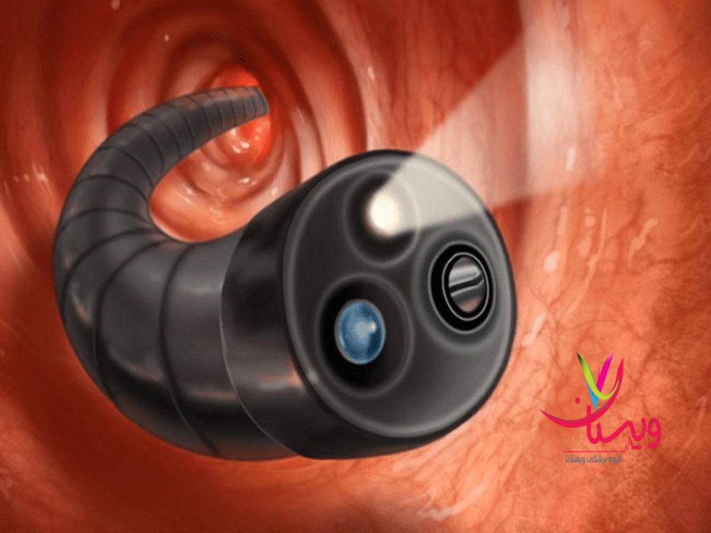 کولونوسکوپی با بیهوشی هزینه کولونوسکوپی با بیمه تکمیلی