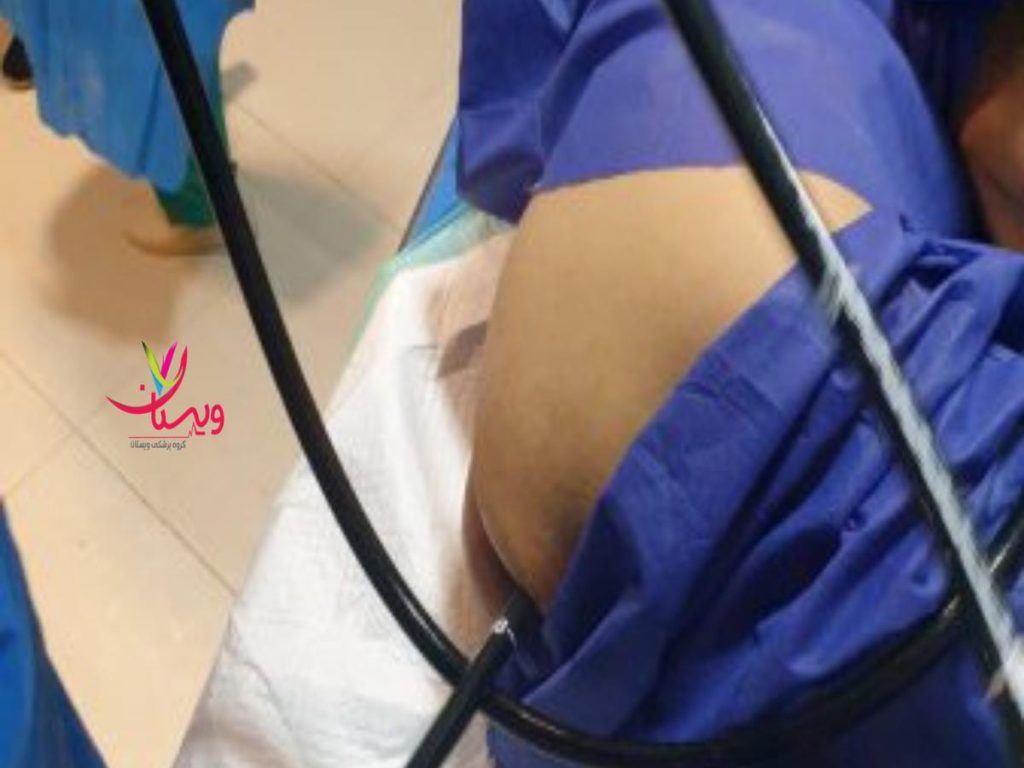 بهترین مرکز کولونوسکوپی هزینه کولونوسکوپی در بیمارستان میلاد