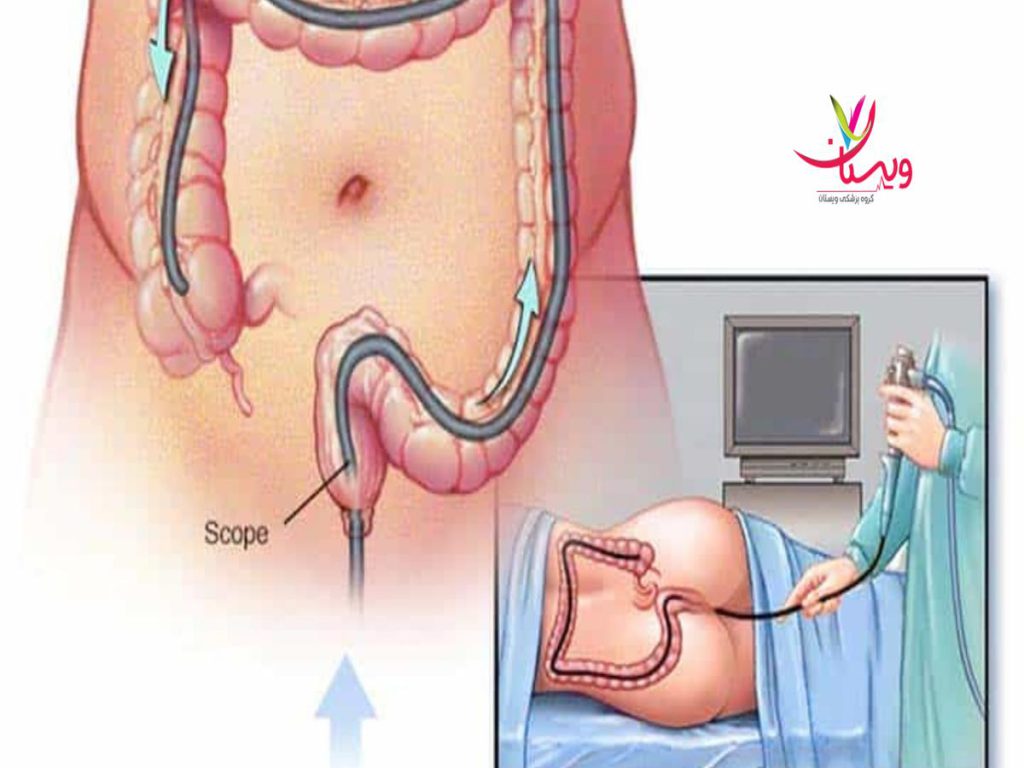 انجام کولونوسکوپی هزینه کولونوسکوپی در بیمارستان پارس