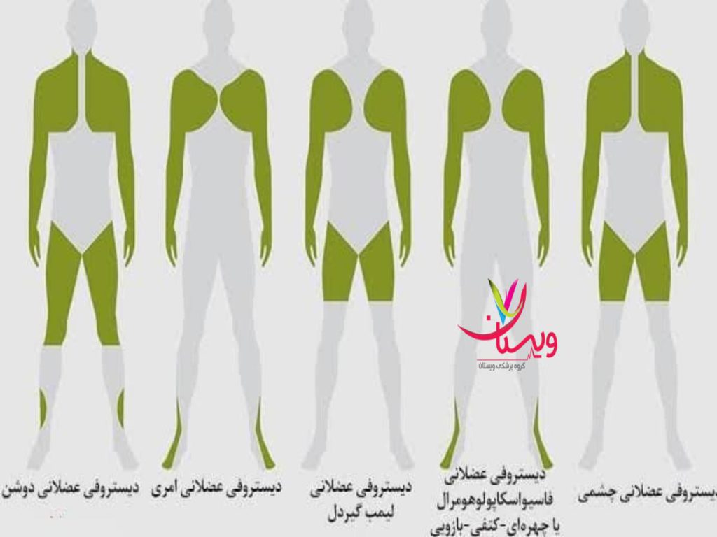 کاهش خشکی عضلات ورزش برای درمان میوپاتی
