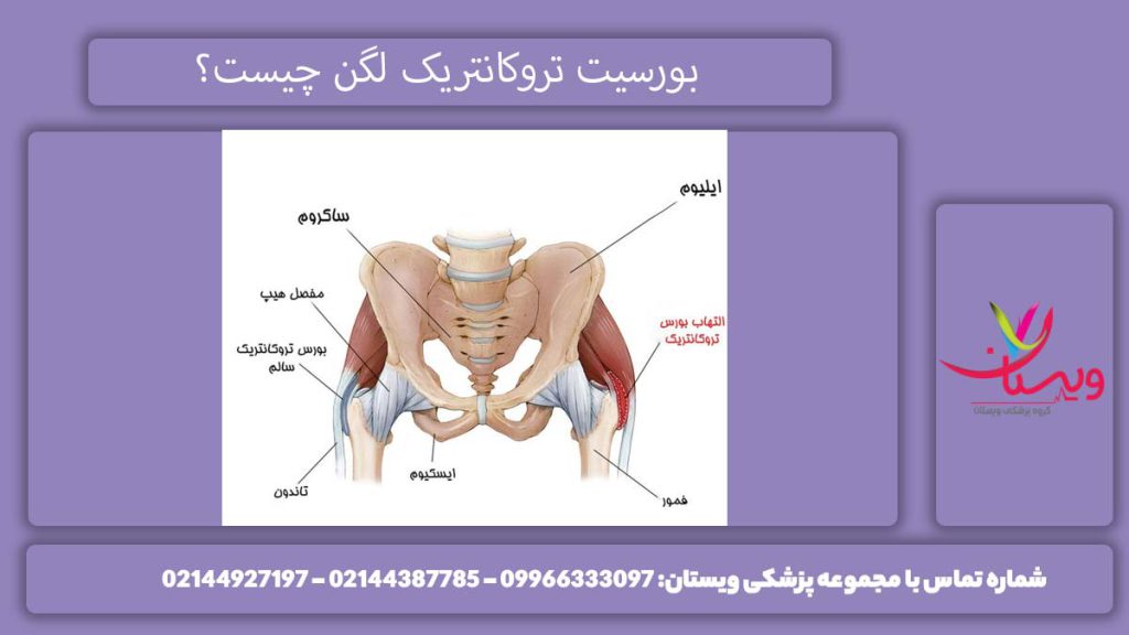 چیستی بورس تروکانتریک بورسیت تروکانتریک لگن چیست؟