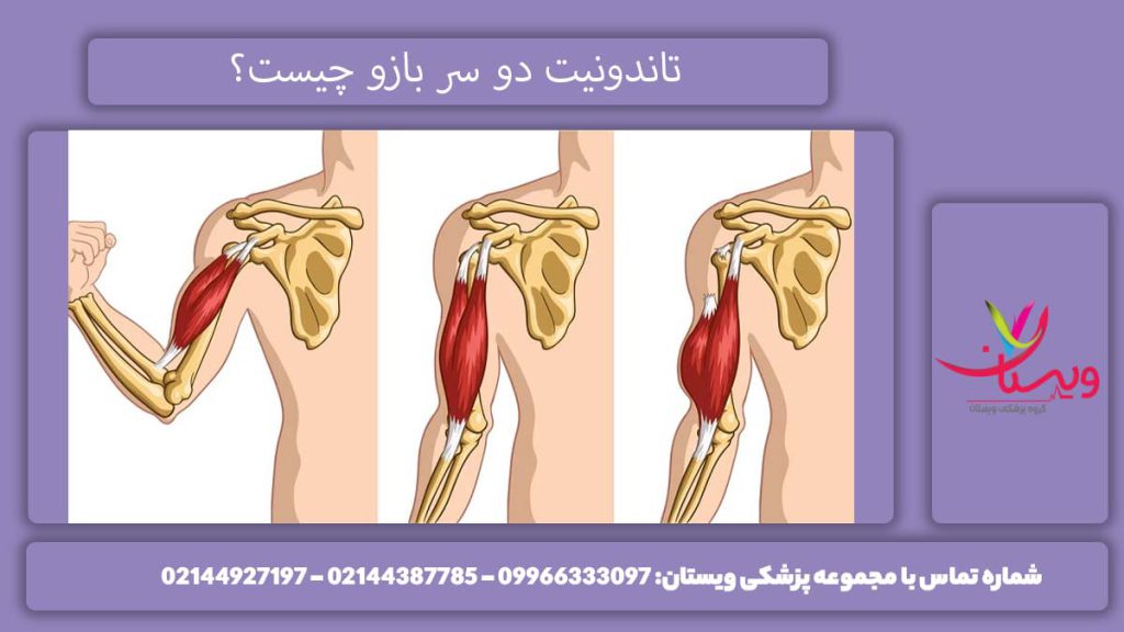 بررسی تاندونیت دوسر بازو تاندونیت دو سر بازو چه میباشد؟