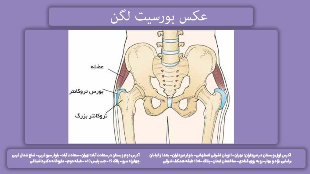 سندروم درد طرفی لگن عکس بورسیت لگن