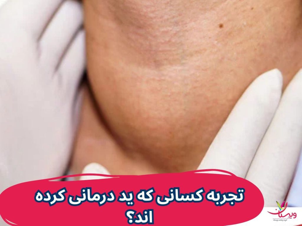 ید درمانی تیروئید تجربه کسانی که ید درمانی کرده اند