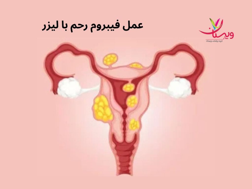 جراحی با لیزر عمل فیبروم رحم با لیزر نی نی سایت