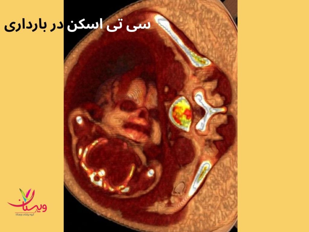 میزان اشعه سیتی اسکن و اثر آن بر بارداری نمیدونستم باردارم سی تی اسکن کردم