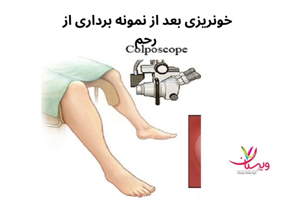 لکهبینی یا خونریزی نمونه برداری خونریزی بعد از نمونه برداری از رحم نی نی سایت
