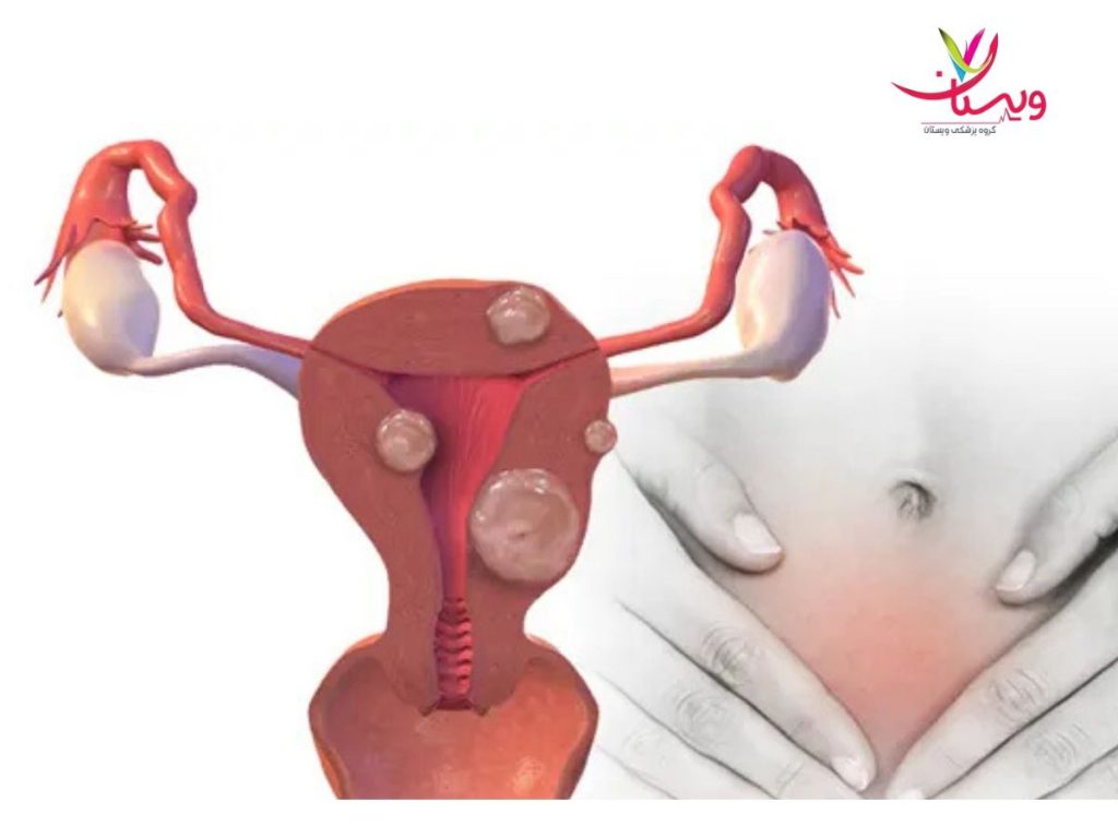 قیمت عمل فیبروم رحم هزینه آمبولیزاسیون رحم نی نی سایت