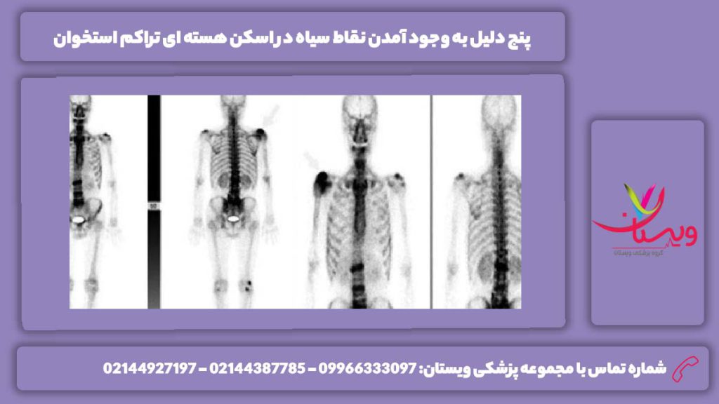 دلایل به وجود آمدن نقاط سیاه در اسکن تراکم استخوان اسکن هسته ای تراکم استخوان