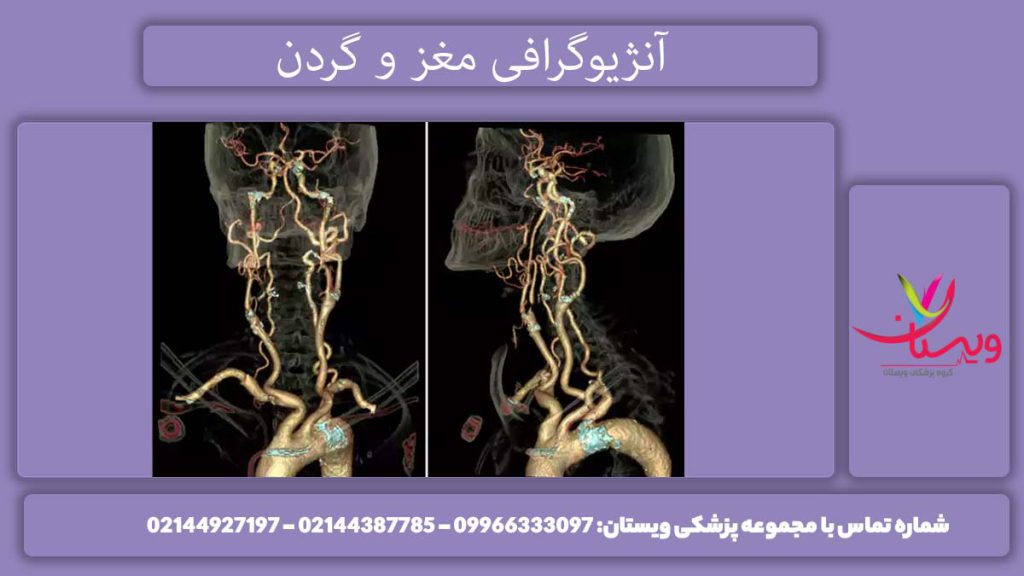 آنژیو سر و گردن چیست؟ سی تی آنژیو سر و گردن برای چیست؟