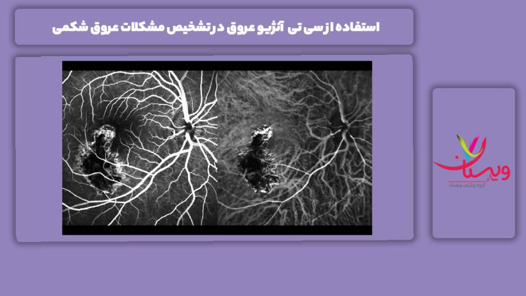 ویژگی این روش غیر تهاجمی برای شکم استفاده از سی تی آنژیو عروق در تشخیص مشکلات عروق شکمی