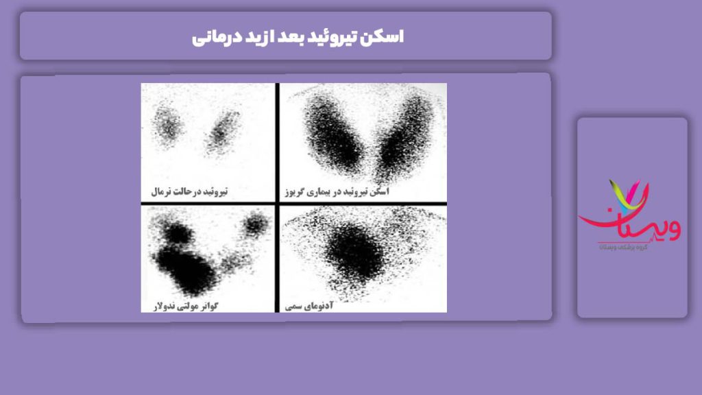 مزیت اسکن تیرودید بعد از ید درمانی اسکن تیروئید بعد از ید درمانی