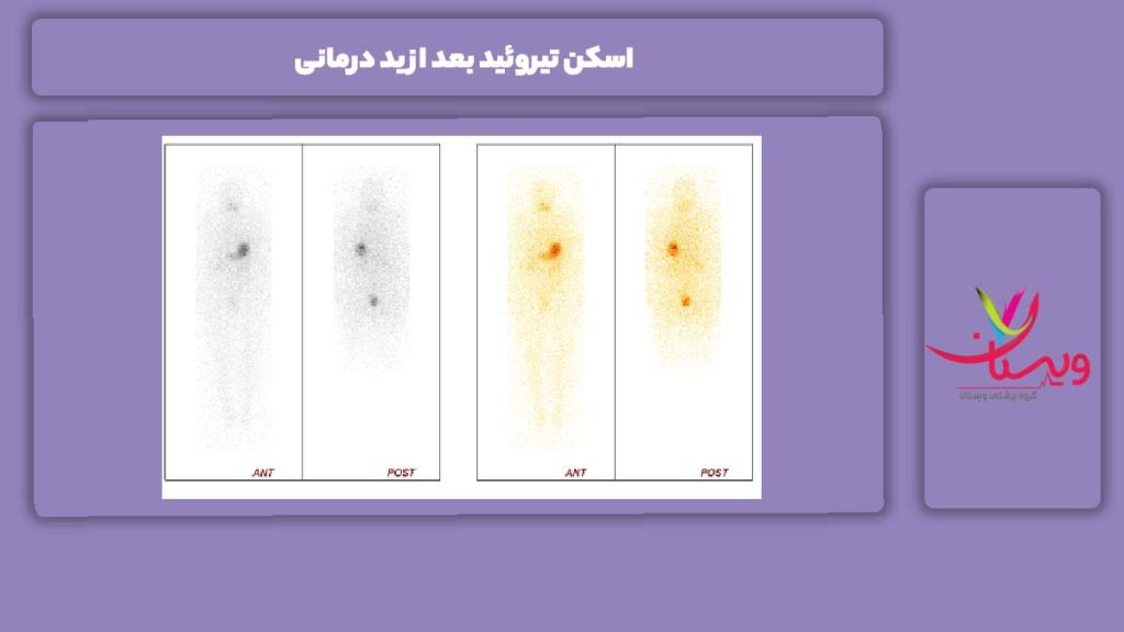 انجام اسکن تیروئید بعد از ید درمانی اسکن تیروئید بعد از ید درمانی