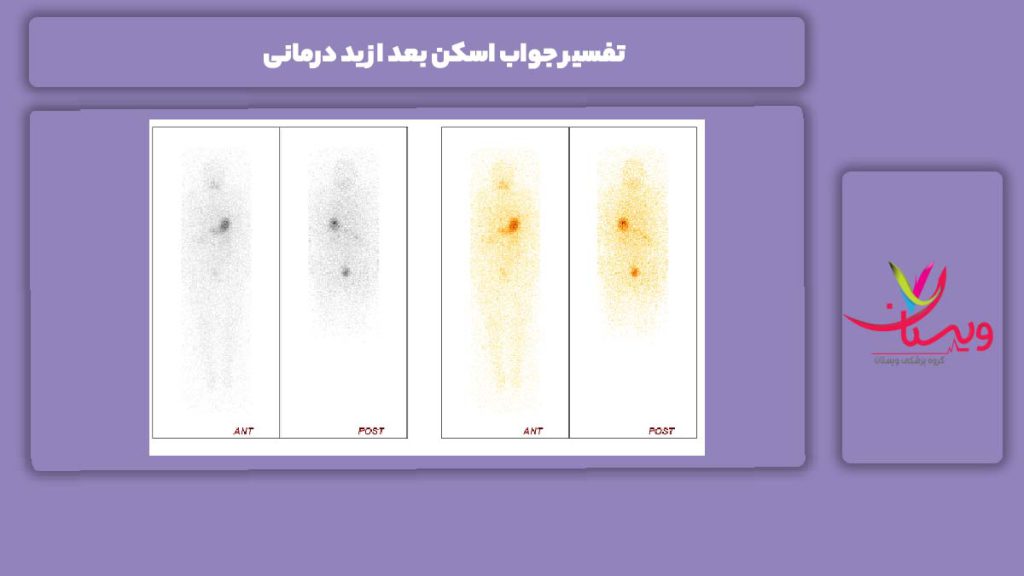 تفسیر جواب اسکن ید تفسیر جواب اسکن بعد از ید درمانی