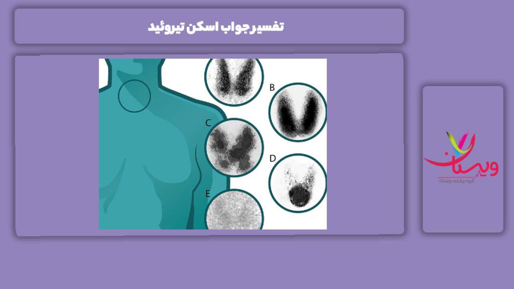 شرح جواب اسکن تیروئید تفسیر جواب اسکن تیروئید
