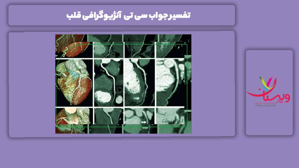 تفسیر سی تی آنژیو تفسیر جواب سی تی آنژیوگرافی قلب