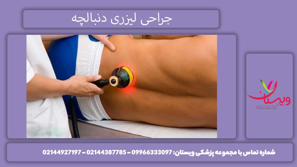 عمل دنبالچه با لیزر چگونه است؟