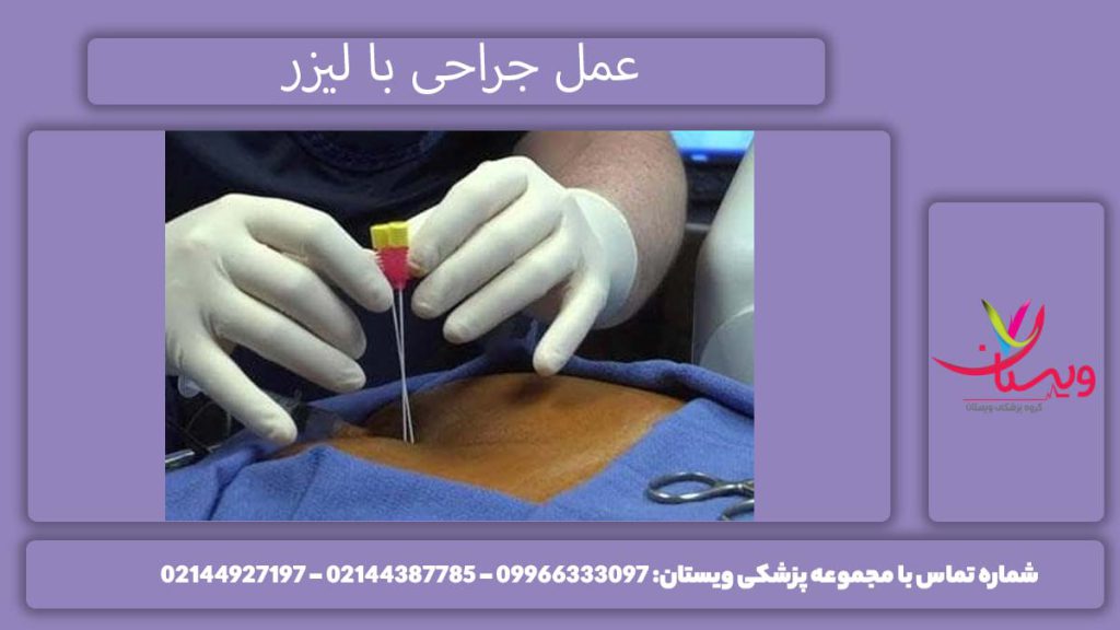 عمل موثر دنبالچه با لیزر بررسی عمل دنبالچه با لیزر