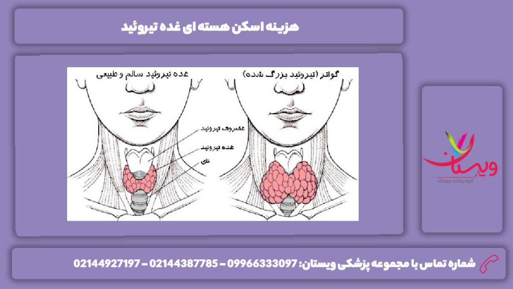 تعرفه اسکن هسته ای برای تیروئید اسکن هسته ای غده تیروئید
