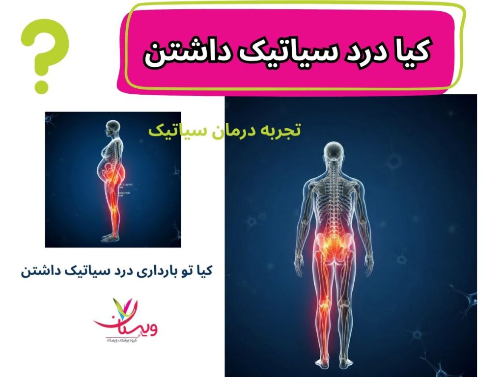 کیا درد سیاتیک داشتن