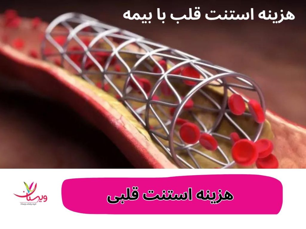 قیمت استنت قلبی ۱۴۰۴ هزینه استنت قلبی