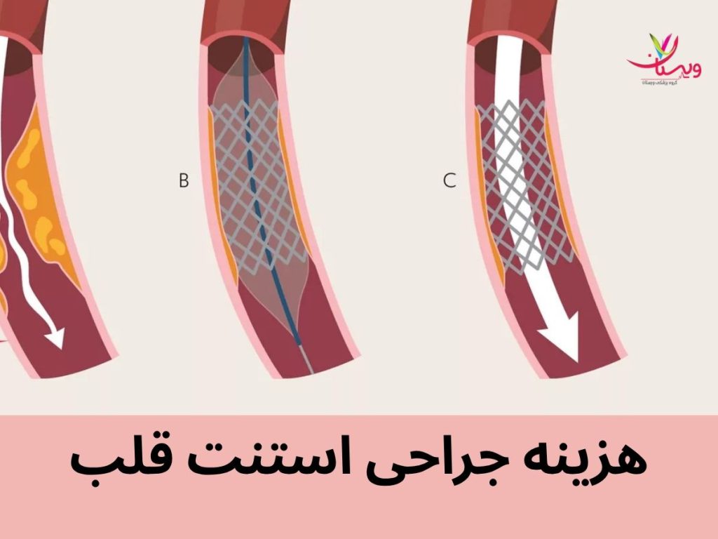 هزینه های جراحی استنت رگ قلب هزینه جراحی استنت قلب