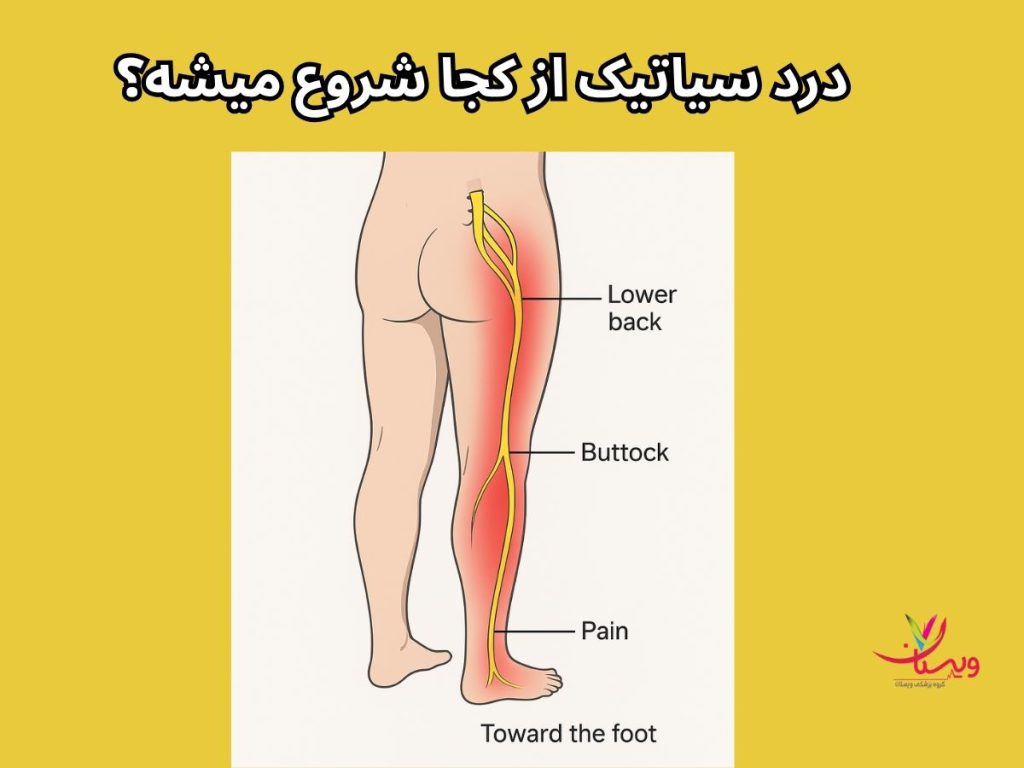 شروع درد سیاتیک درد سیاتیک از کجا شروع میشه؟