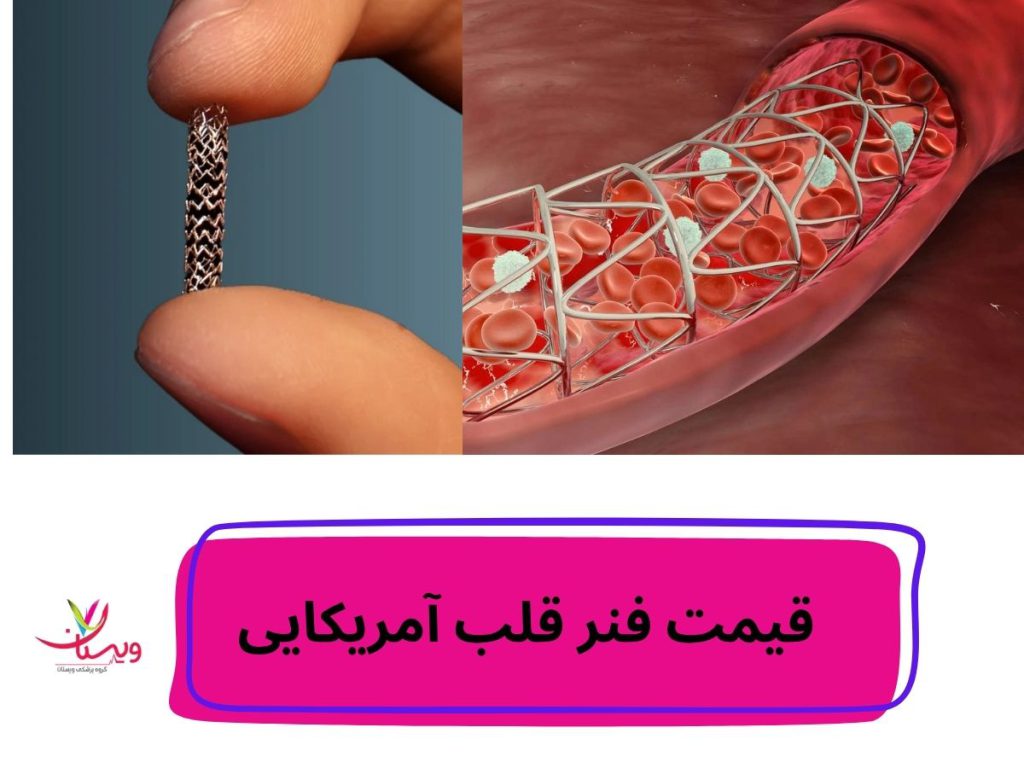 قیمت اسنت قلبی قیمت فنر قلب آمریکایی