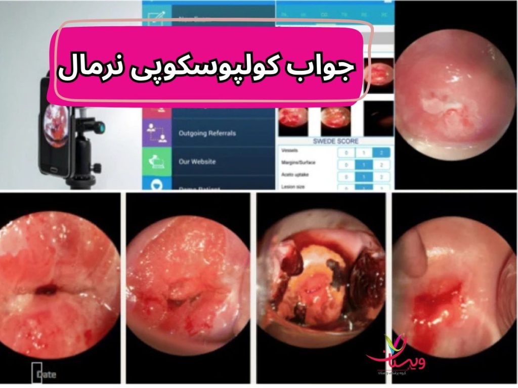 عکس جواب کولپوسکوپی