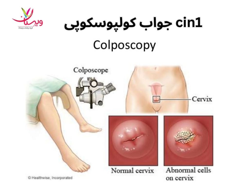 جواب کولپوسکوپی cin1