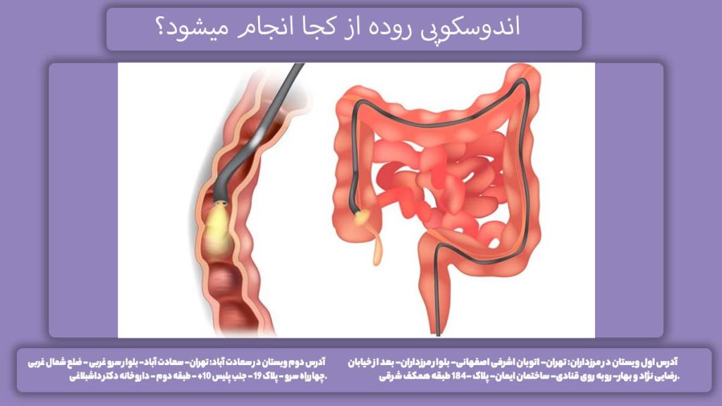 آندوسکوپی از کدام اندام بدن انجام میشود؟ آندوسکوپی روده از کجا انجام میشود؟