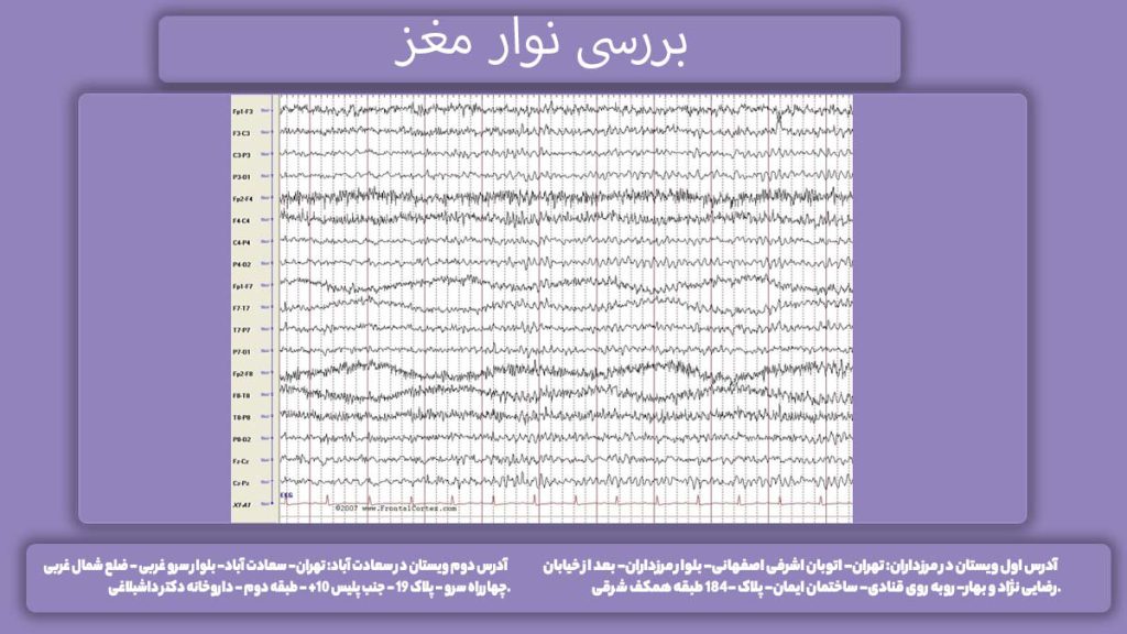 بررسی نوار مغز تفسیر نوار مغز