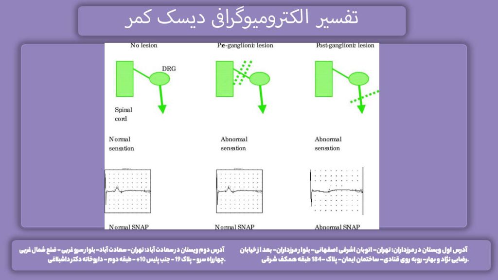 تحلیل نتایج تفسیر تفسیر الکترومیوگرافی دیسک کمر