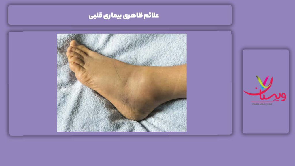 نشانههای ظاهری بیماریهای قلبی علائم ظاهری بیماری قلبی