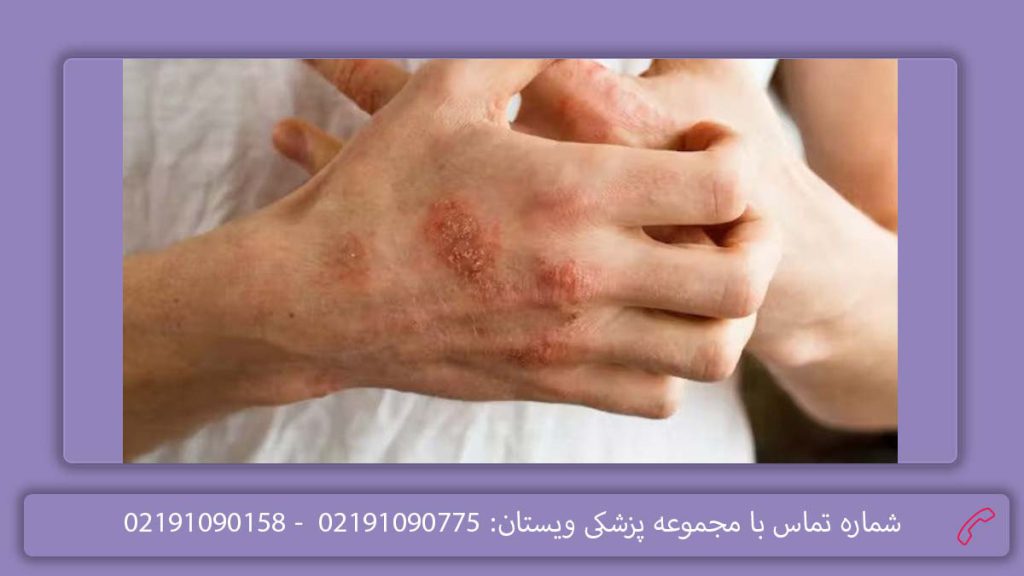 تب روماتیسمی قلبی عکس آسیب روماتیسمی قلب