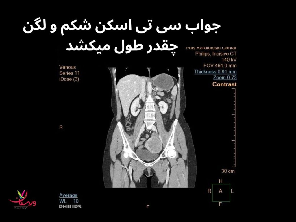 سی تی اسکن شکم ولگن جواب سی تی اسکن شکم و لگن چقدر طول میکشد