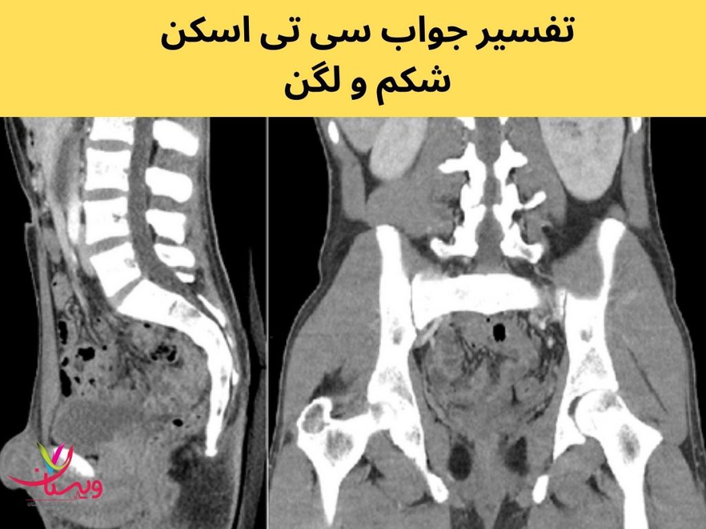 نتیجه سی تی اسکن شکم و لگن تفسیر جواب سی تی اسکن شکم و لگن