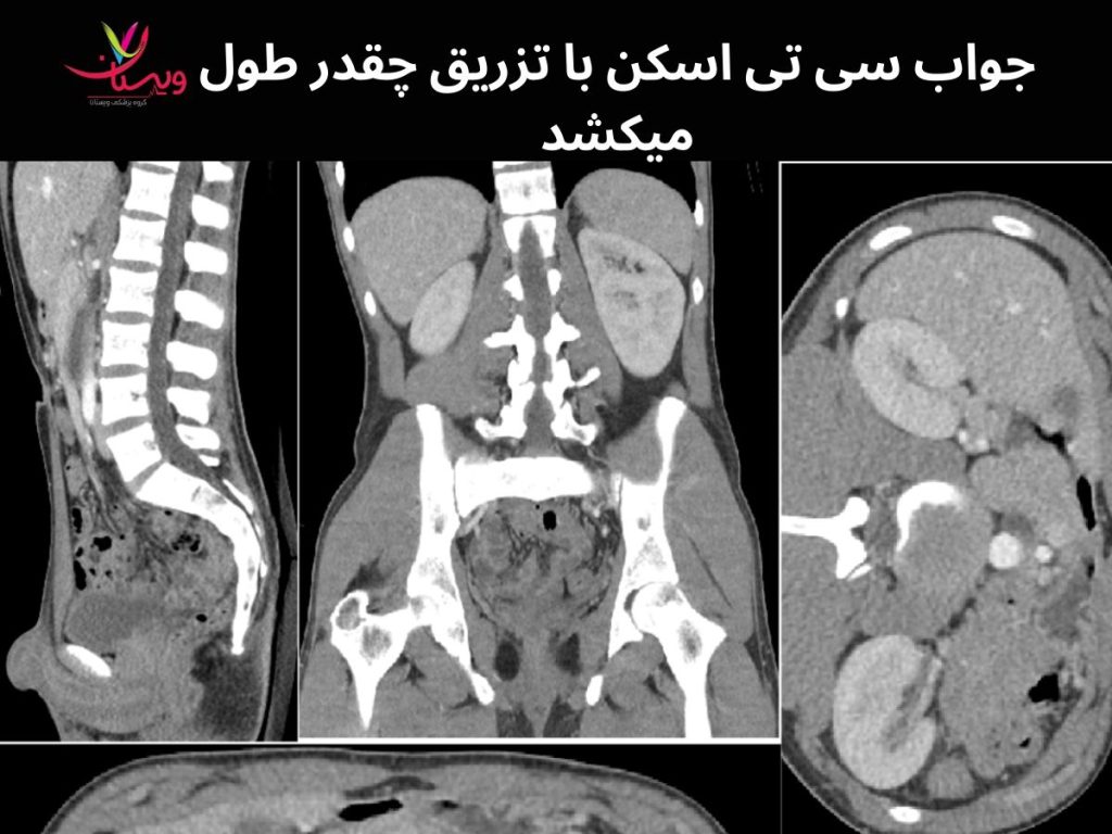 سی تی اسکن با تزریق جواب سی تی اسکن با تزریق چقدر طول میکشد