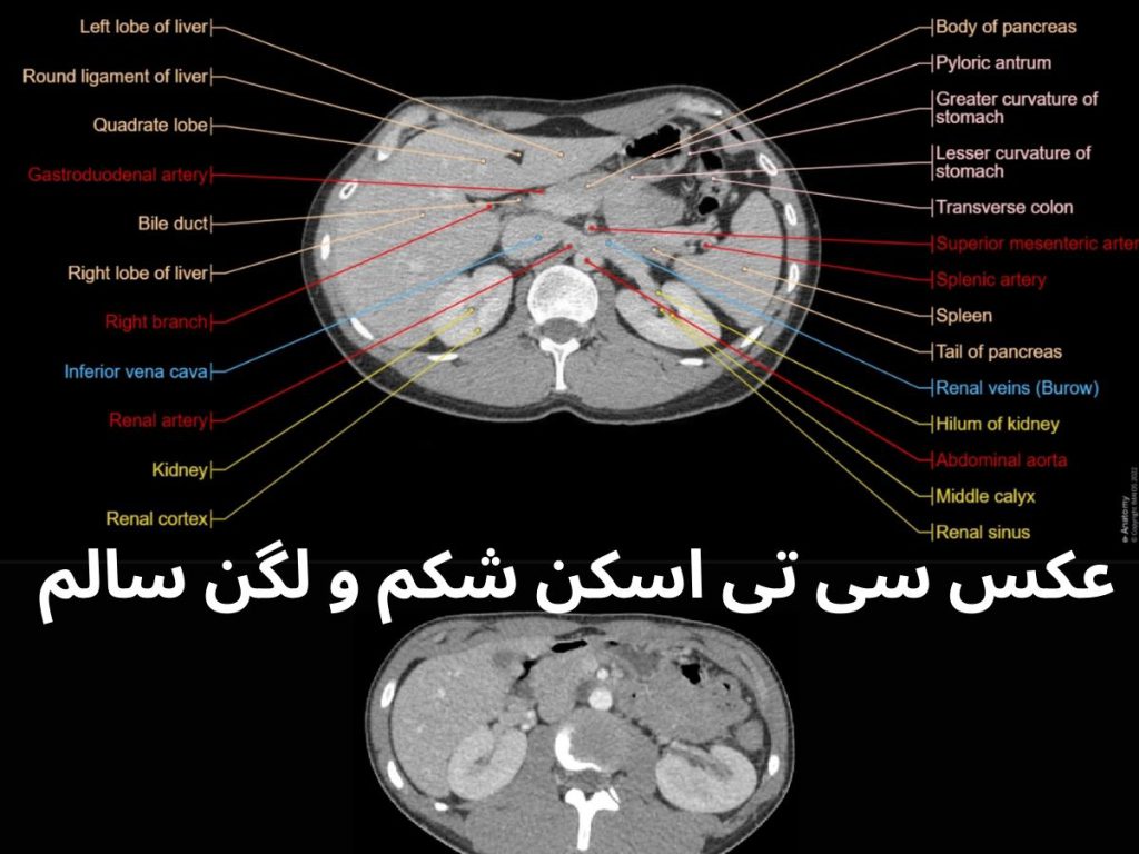 سی تی اسکن شکم سالم عکس سی تی اسکن شکم و لگن سالم